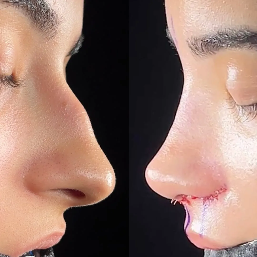 natural-nose-9