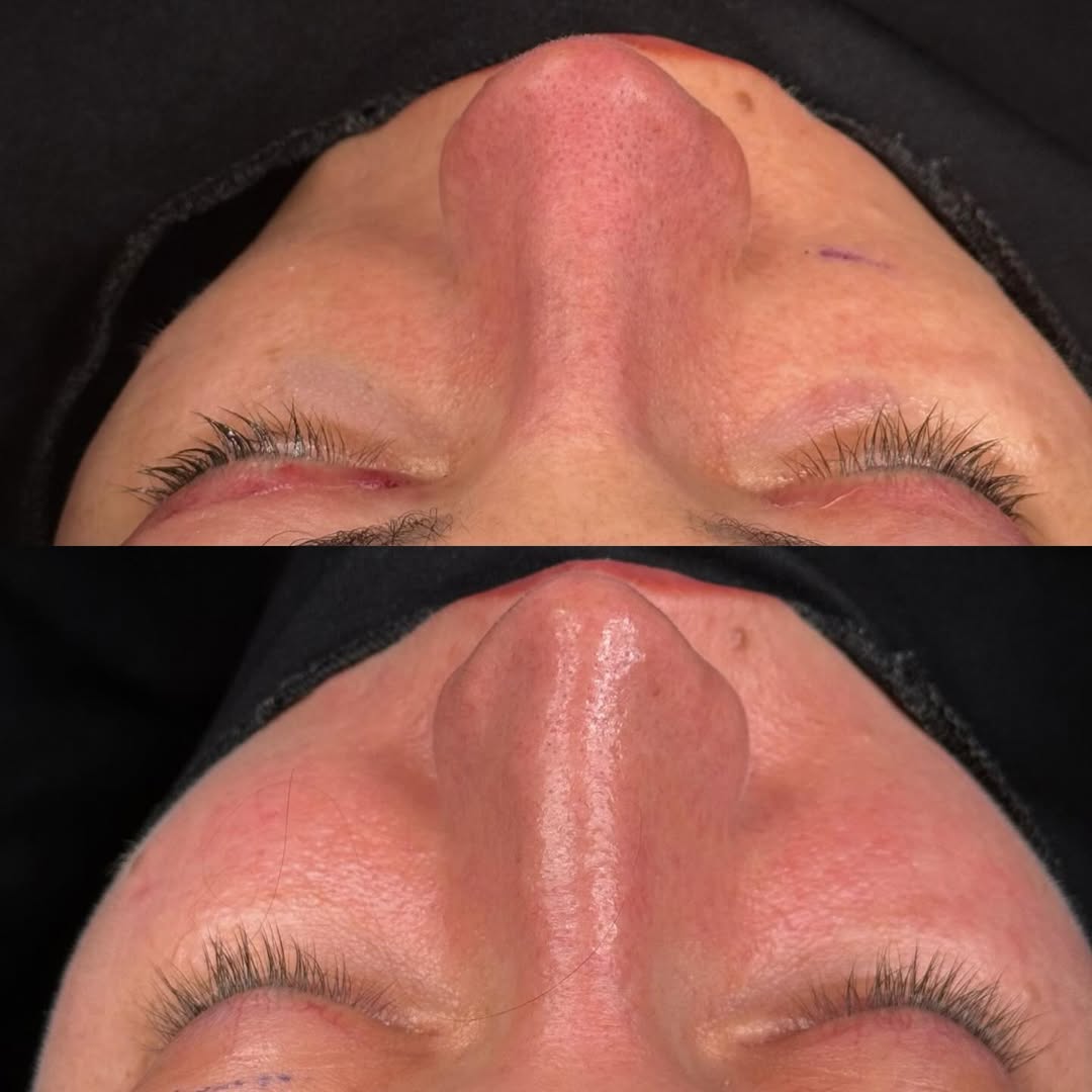 natural-rhinoplasty-turkey-antalya-before-after-2