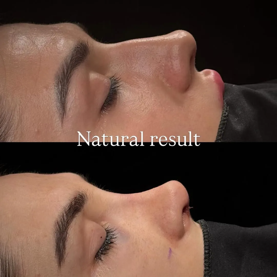 natural-rhinoplasty-turkey-antalya-before-after-3