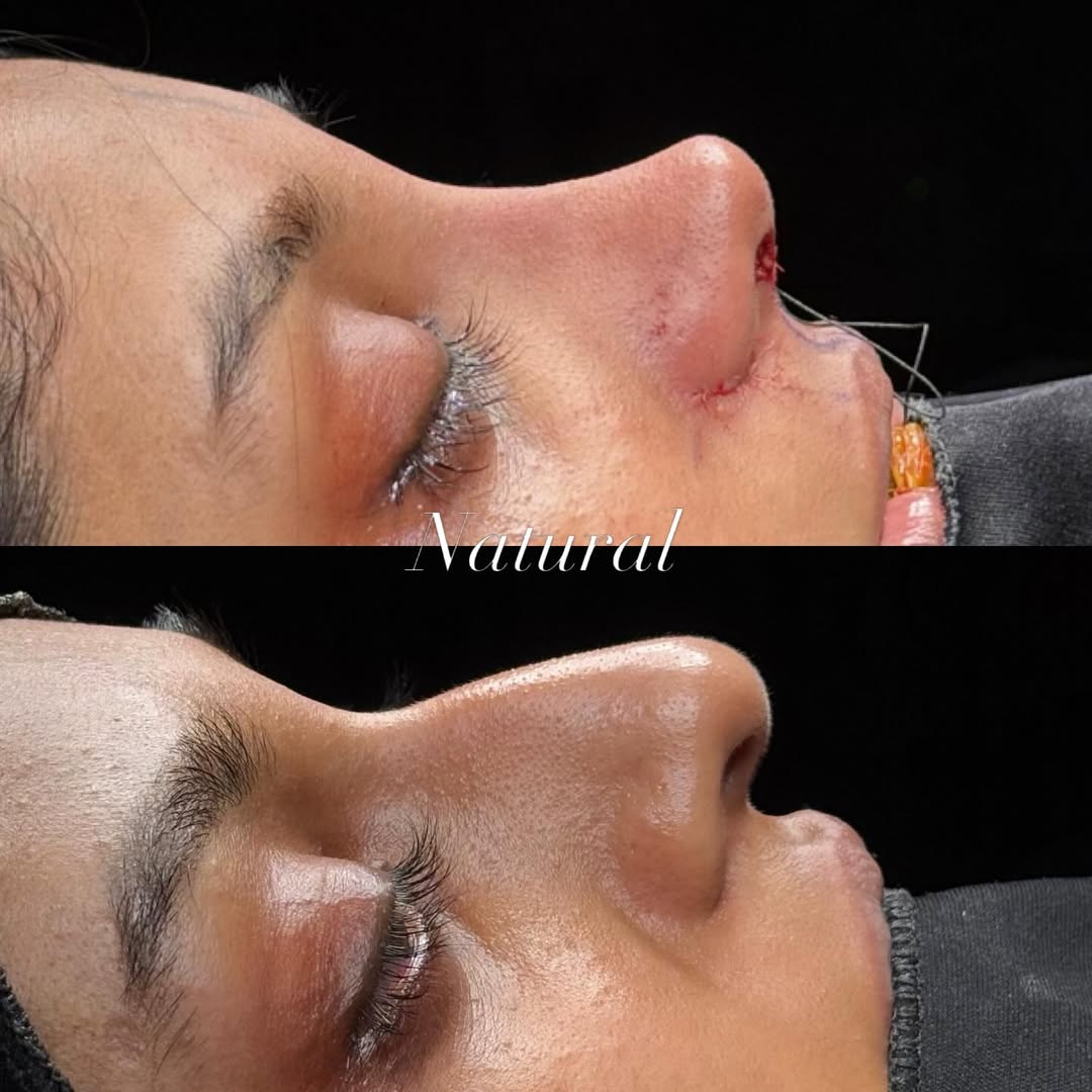 natural-rhinoplasty-turkey-antalya-before-after-6