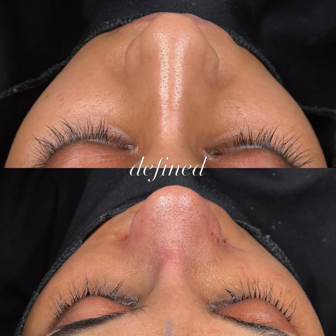 natural-rhinoplasty-turkey-antalya-before-after-7