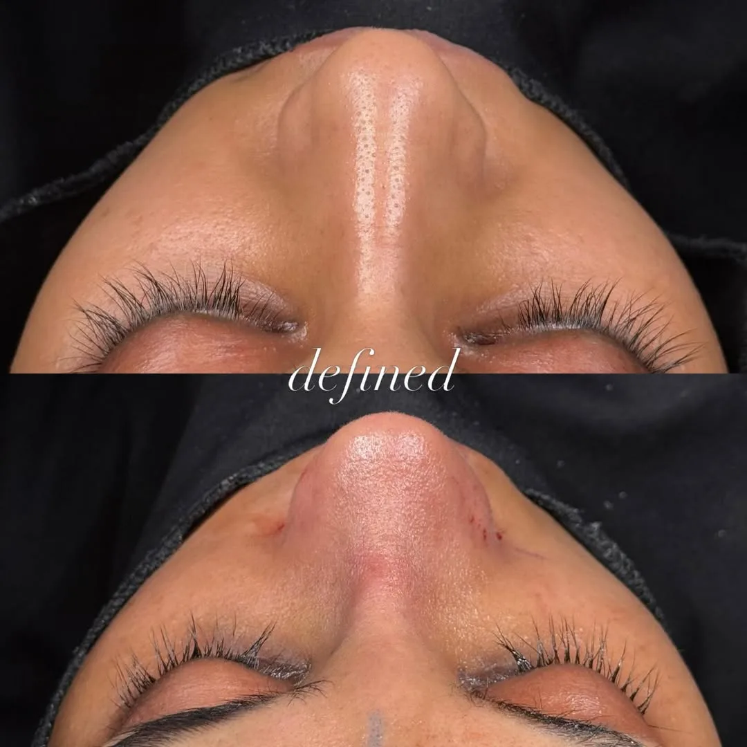 natural-rhinoplasty-turkey-antalya-before-after-7