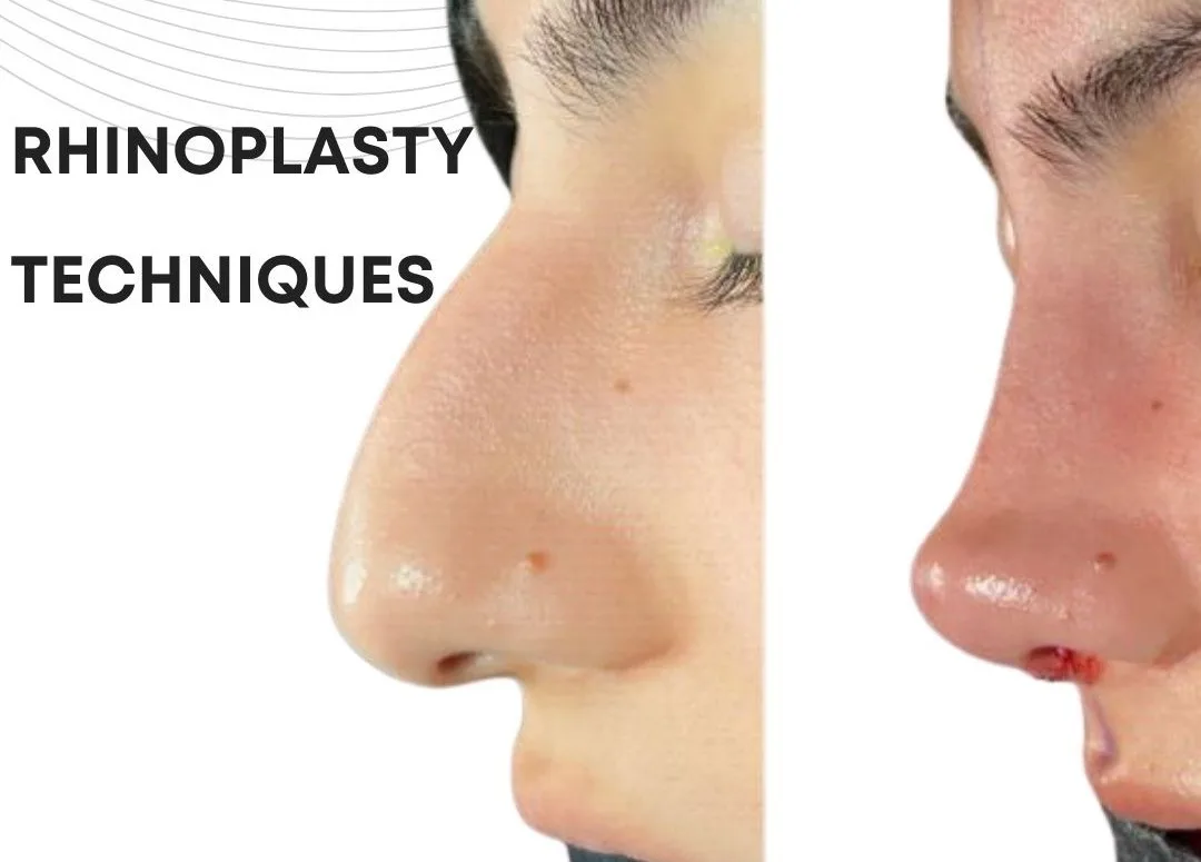 What are the different Rhinoplasty / Nose Job Techniques in Turkey, Antalya