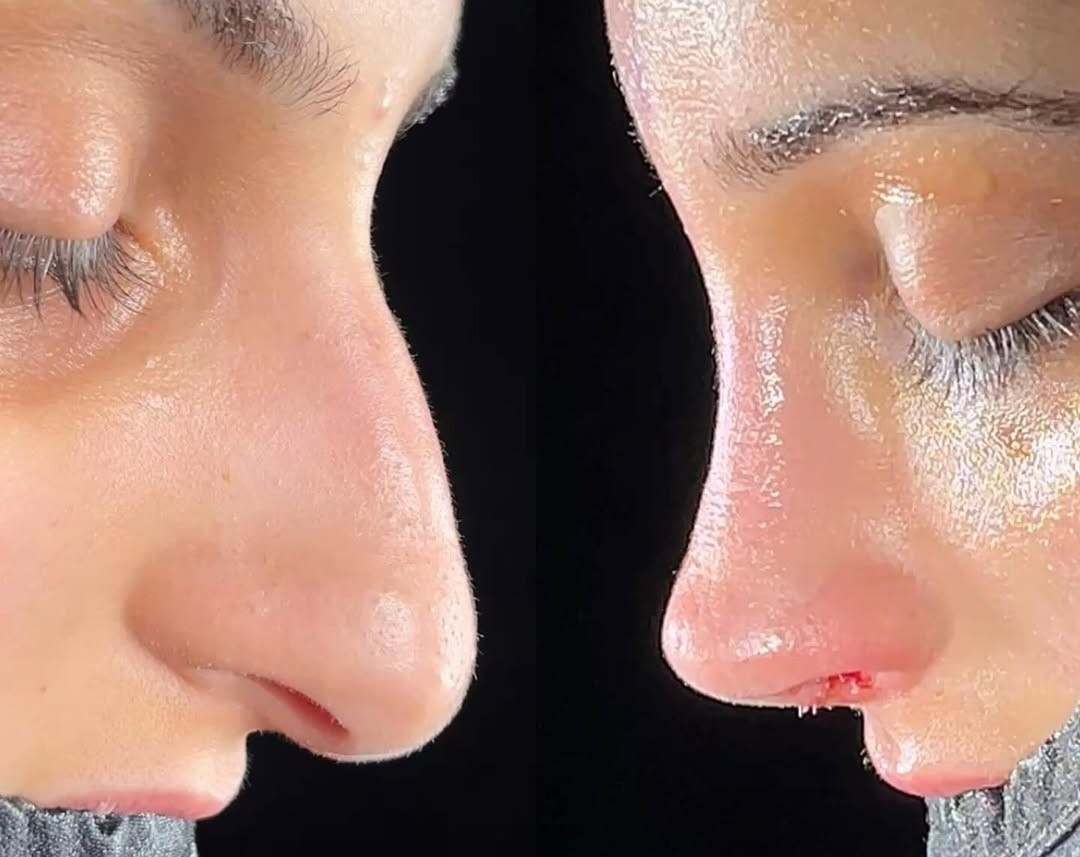 How much does the nose shrink after rhinoplasty? How much does the nose shrink after rhinoplasty?