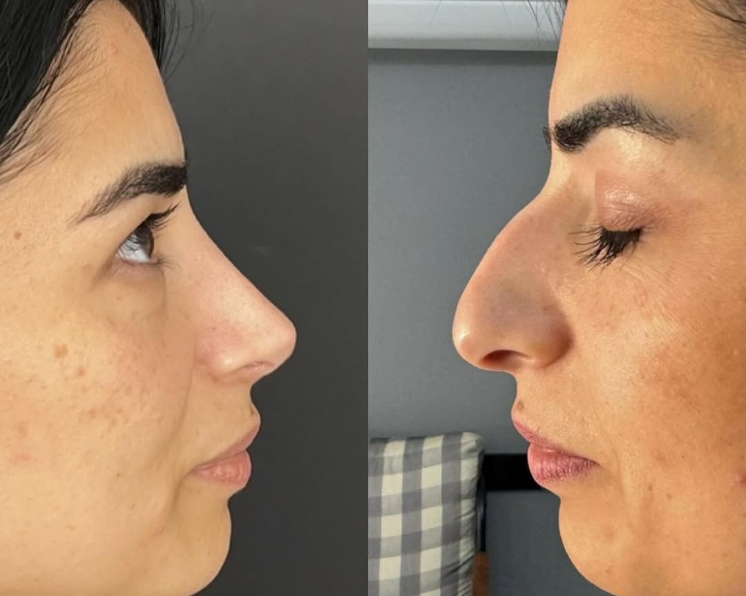 1-year rhinoplasty results 1-year rhinoplasty results