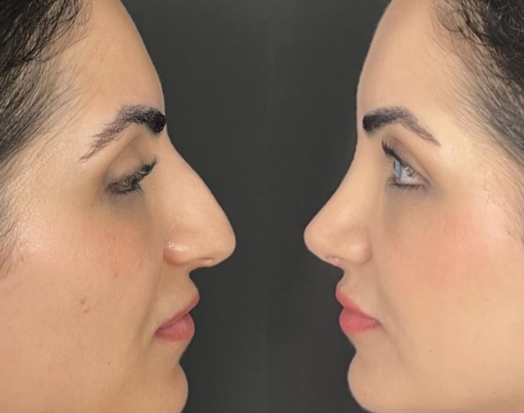 1-year rhinoplasty results 1-year rhinoplasty results