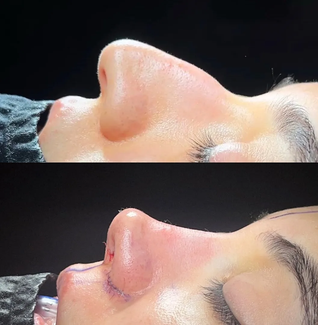 Nose tip aesthetics in Turkey, Antalya