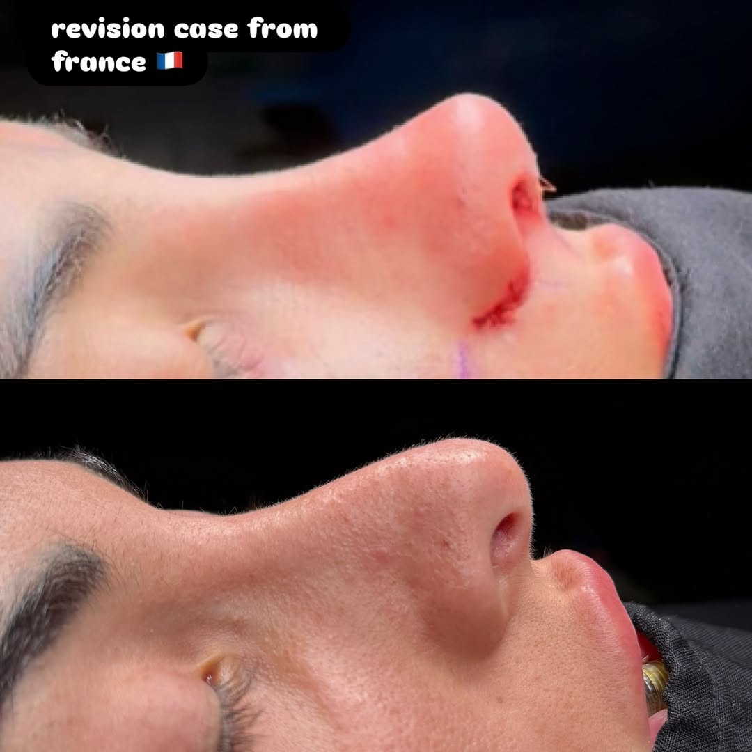 Revision rhinoplasty for Pollybeak deformity Revision rhinoplasty for Pollybeak deformity