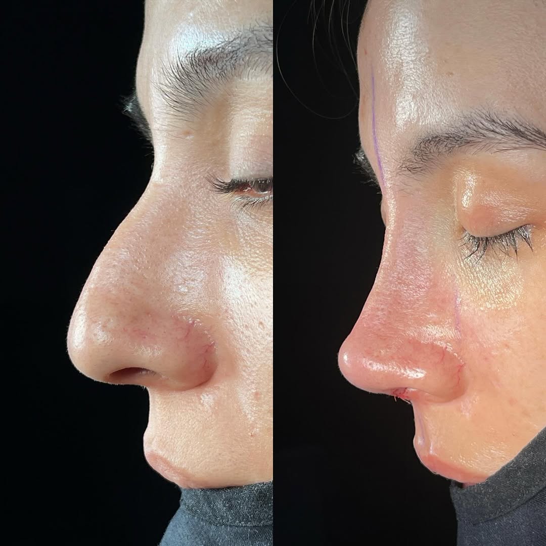 Pollybeak deformity Pollybeak deformity