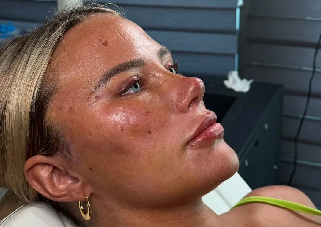 After one week: Barbie Nose and Endoscopic Midface Lift