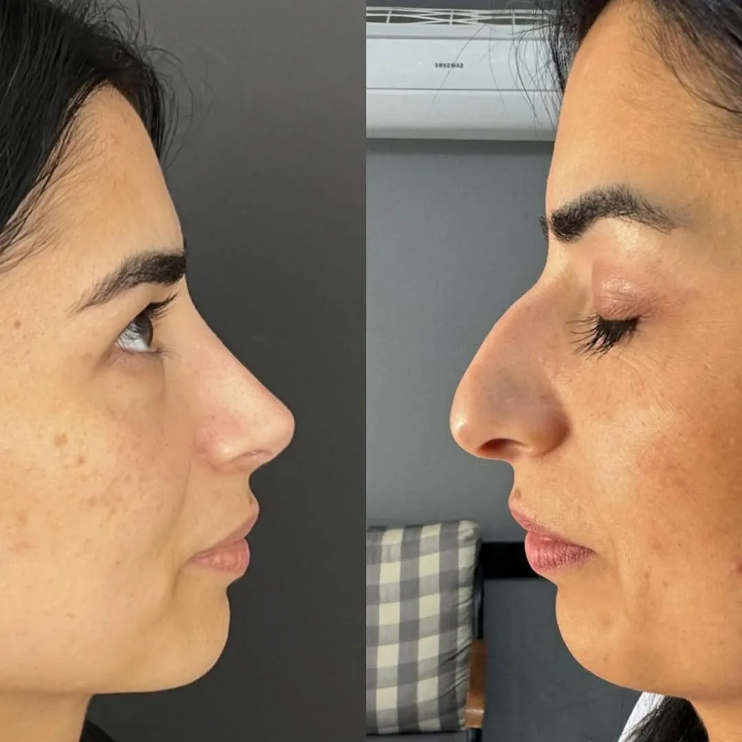 1 year post-surgery