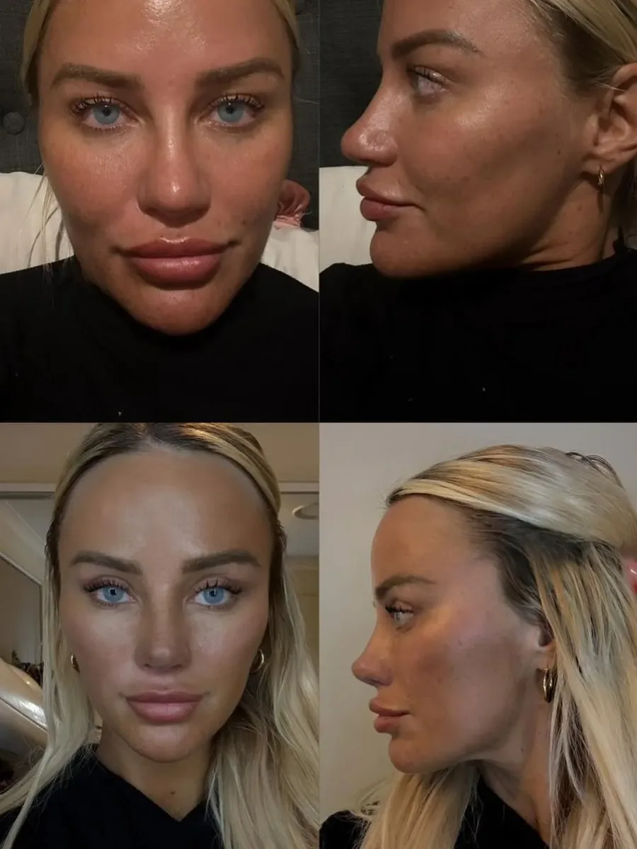 Two weeks post-op of rhinoplasty 