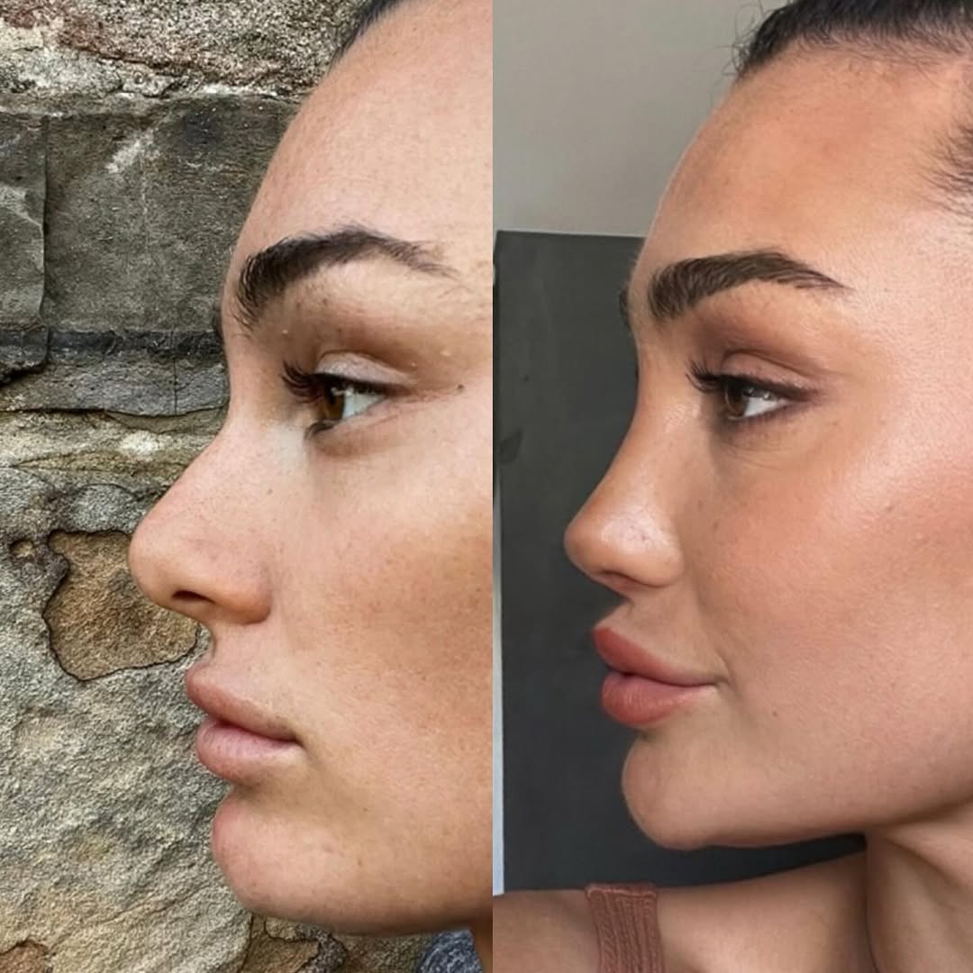 3 months post-surgery 3 months post-surgery