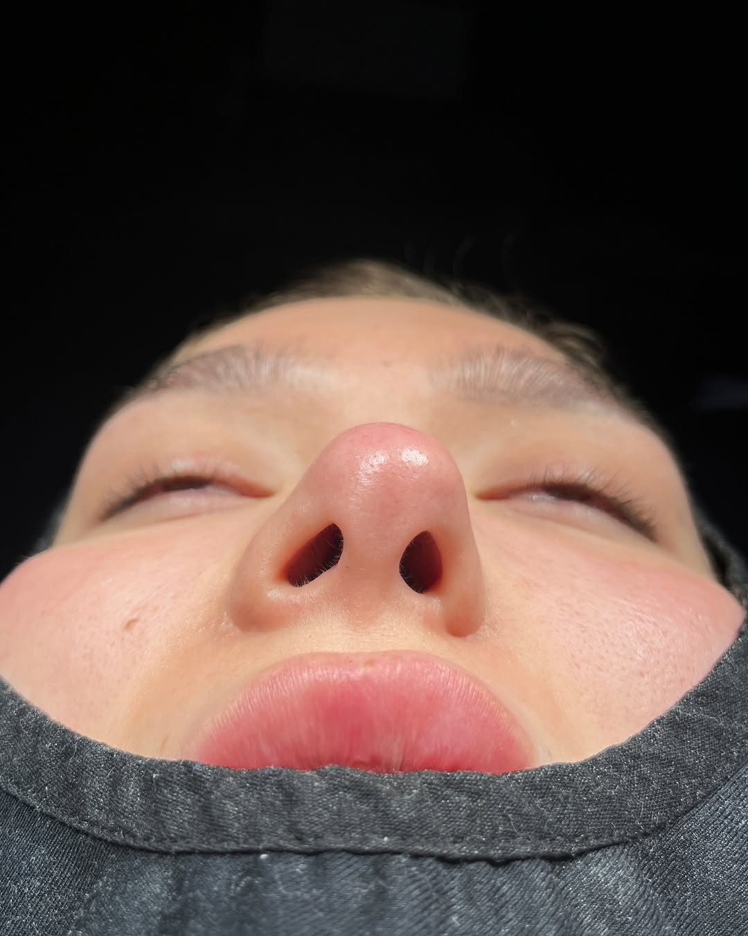 Revision Rhinoplasty Before and After-1