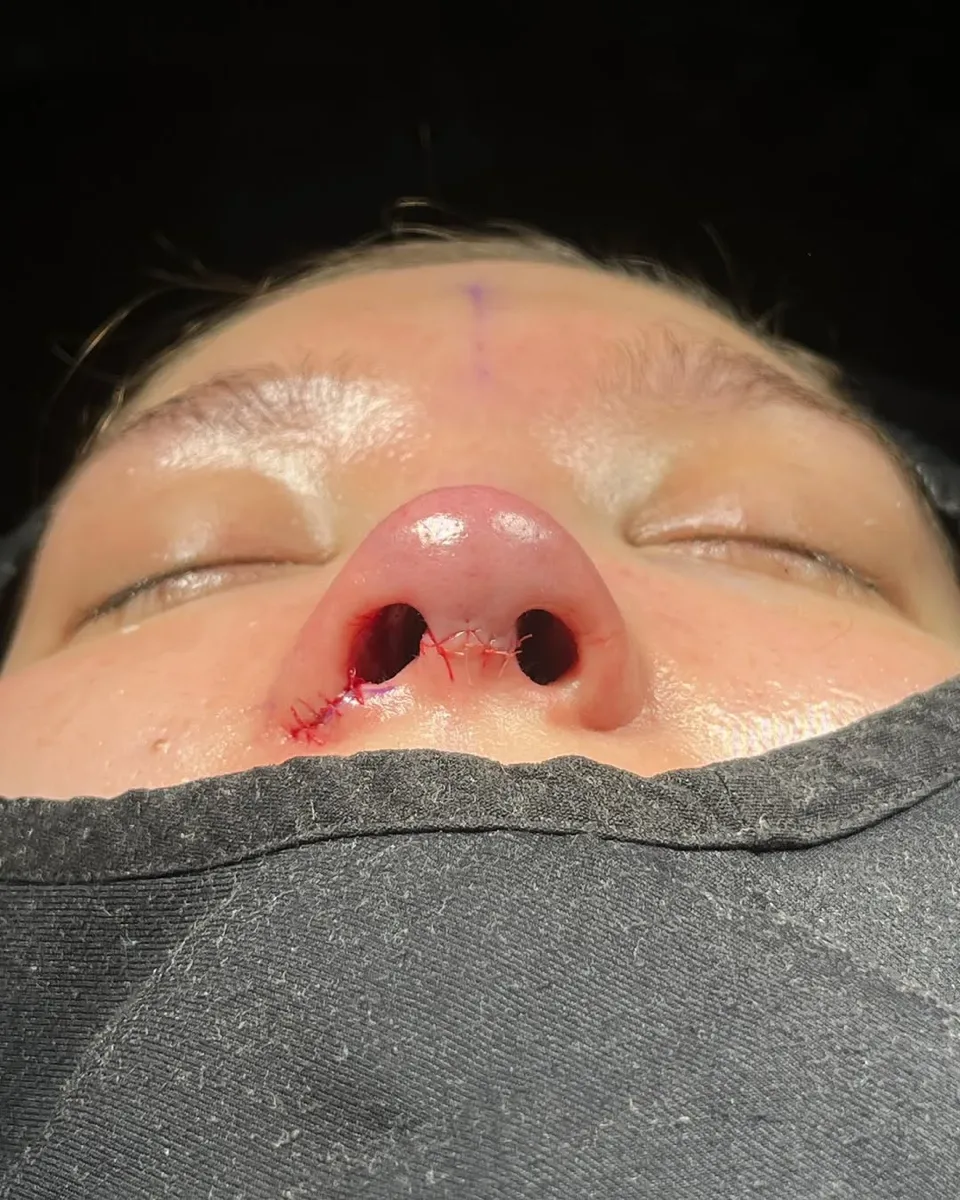Revision Rhinoplasty Before and After-2