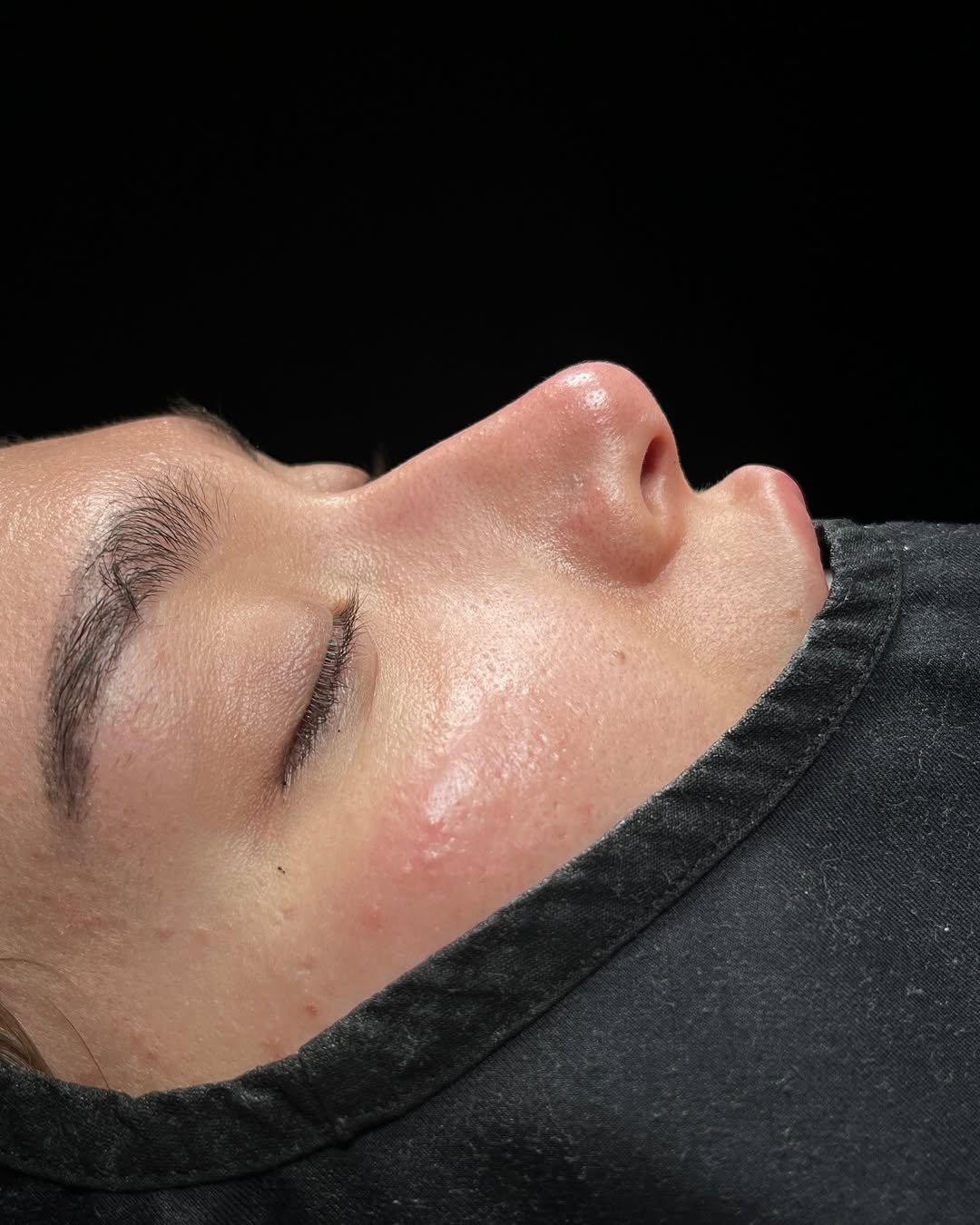 Revision Rhinoplasty Before and After-3