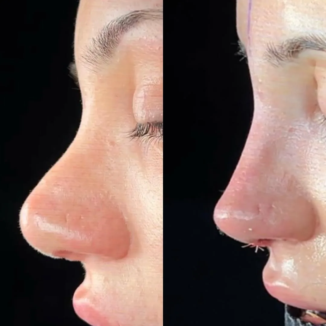 Is it possible to have the third rhinoplasty? 