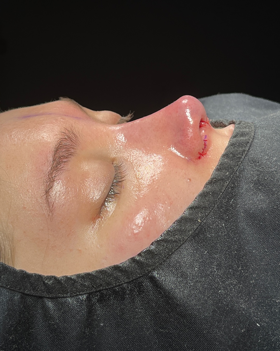 Revision Rhinoplasty Before and After-4