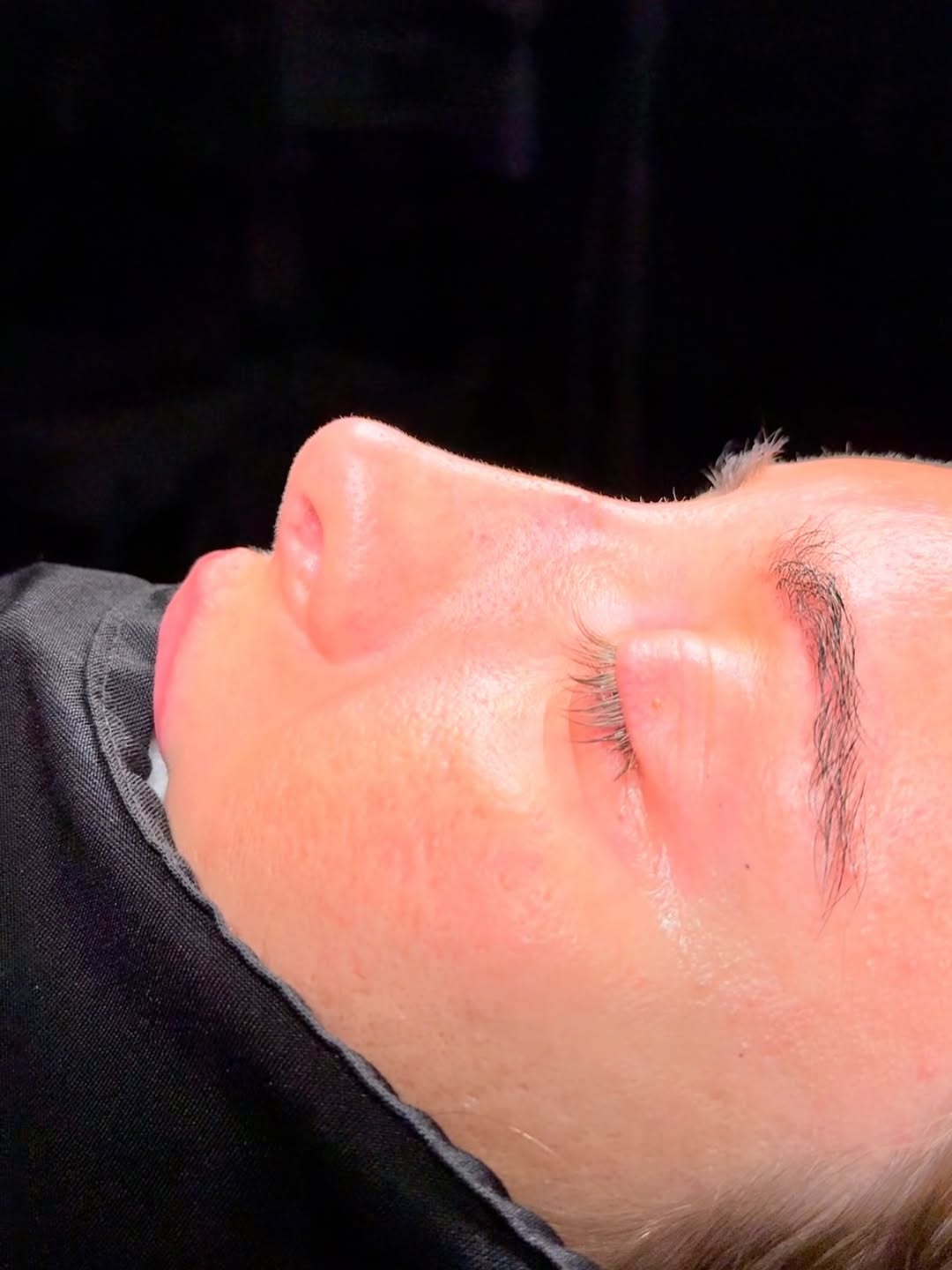Revision Rhinoplasty Before and After-5