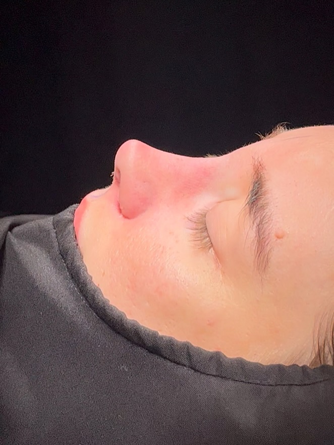 Revision Rhinoplasty Before and After-6