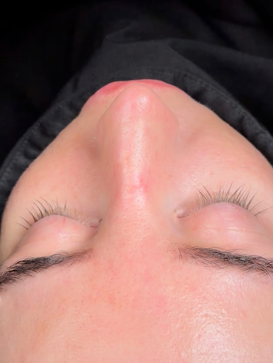 Revision Rhinoplasty Before and After-7