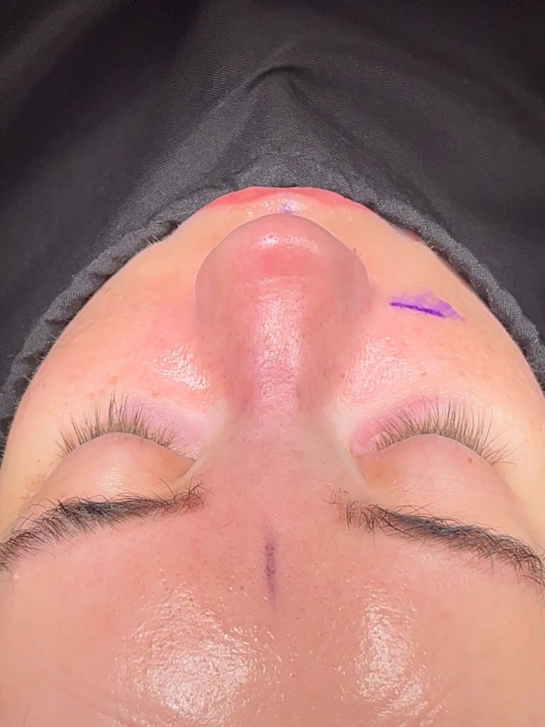 Revision Rhinoplasty Before and After-8