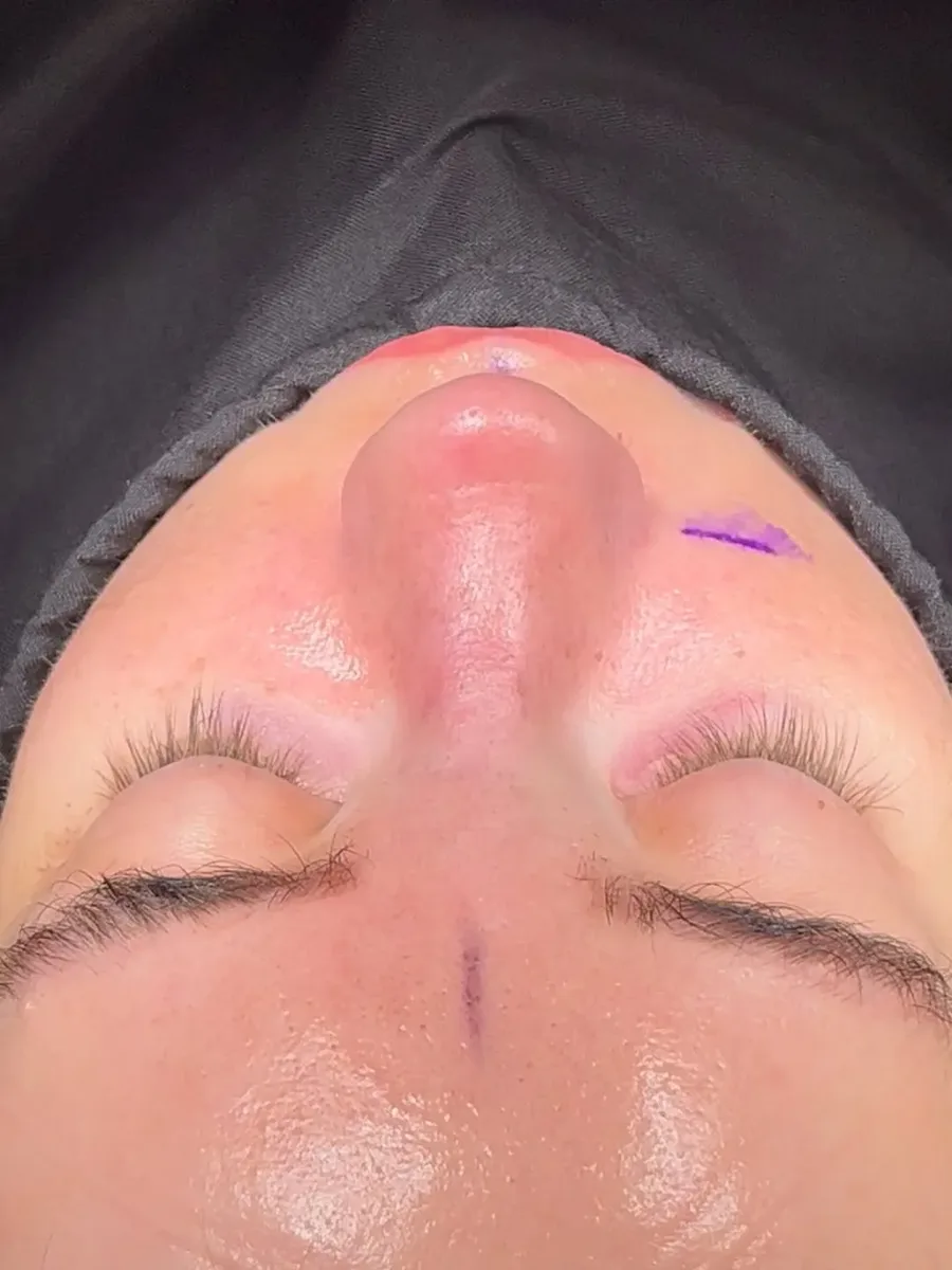Revision Rhinoplasty Before and After-8
