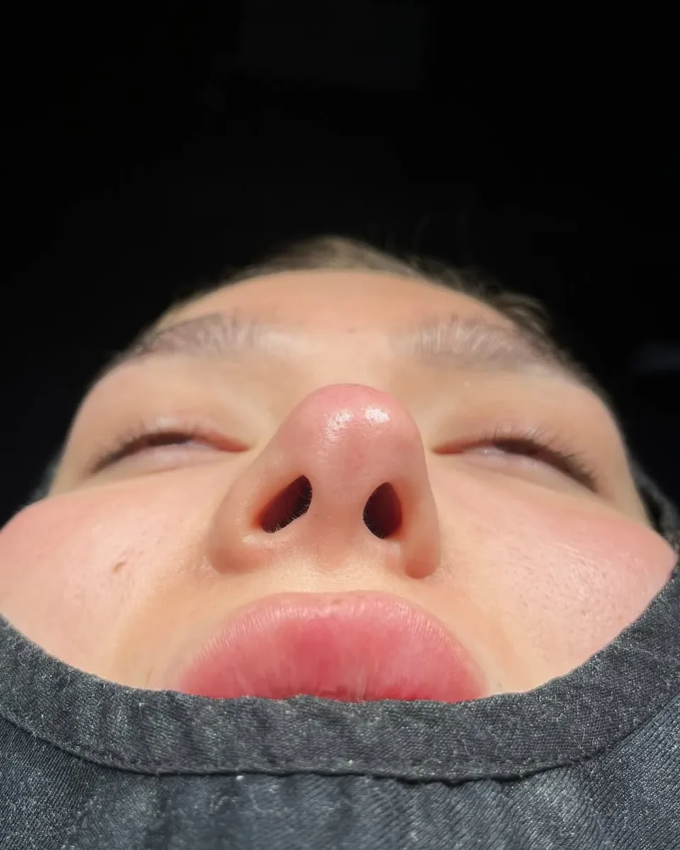 revision rhinoplasty in Turkey, Antalya? Why choose revision rhinoplasty in Turkey, Antalya?