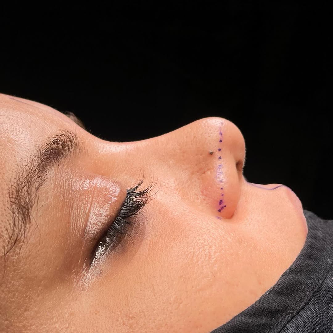 Why choose revision rhinoplasty in Turkey, Antalya?