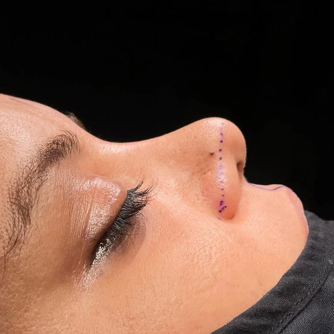 revision rhinoplasty in Turkey, Antalya? Why choose revision rhinoplasty in Turkey, Antalya?