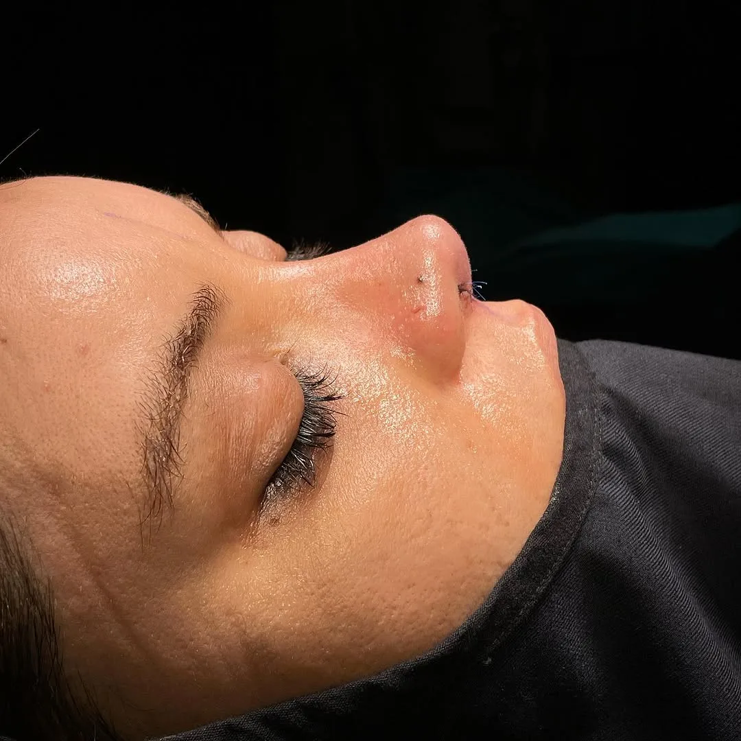 revision rhinoplasty in Turkey, Antalya? Why choose revision rhinoplasty in Turkey, Antalya?
