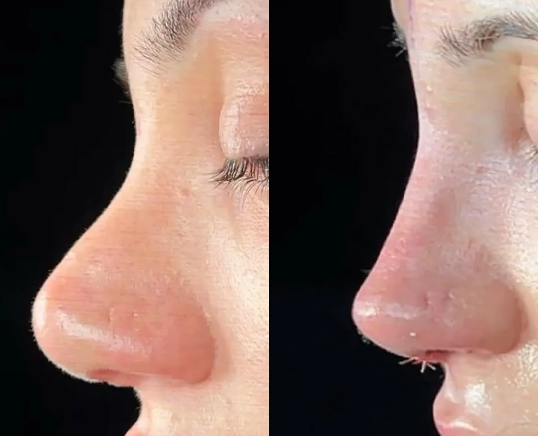 Why choose revision rhinoplasty in Turkey, Antalya? Why choose revision rhinoplasty in Turkey, Antalya?