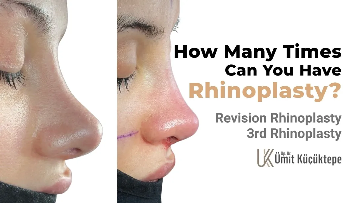 How many times can you have rhinoplasty? 