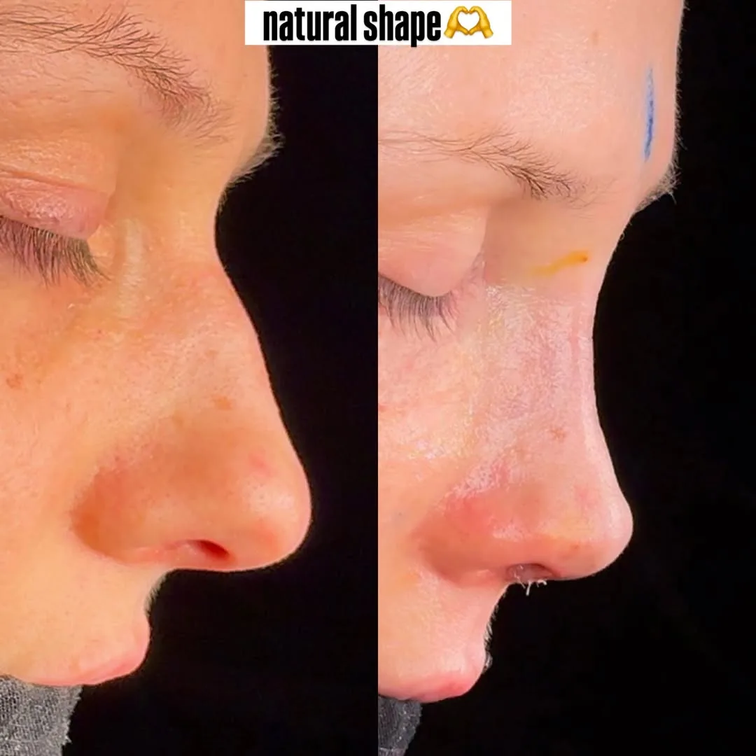 Natural nose shape