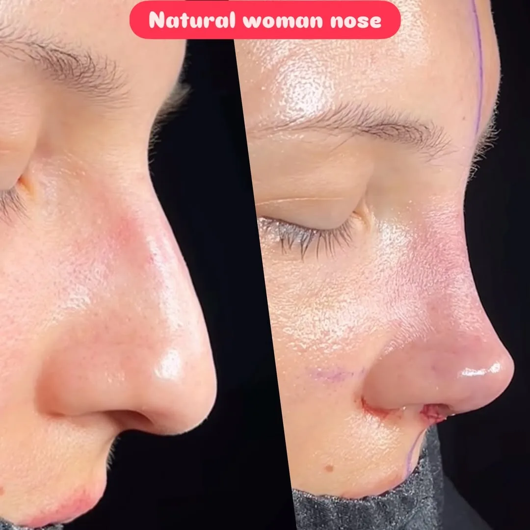 Natural nose 