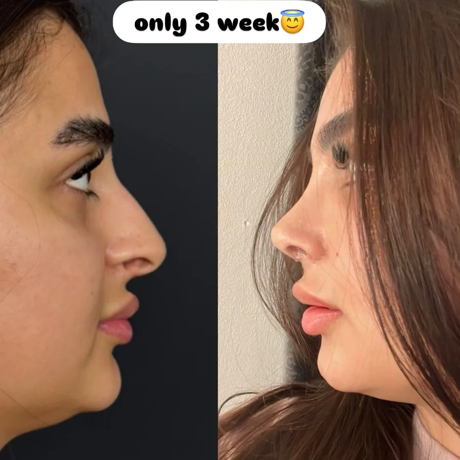 Half Babie half Natural nose result