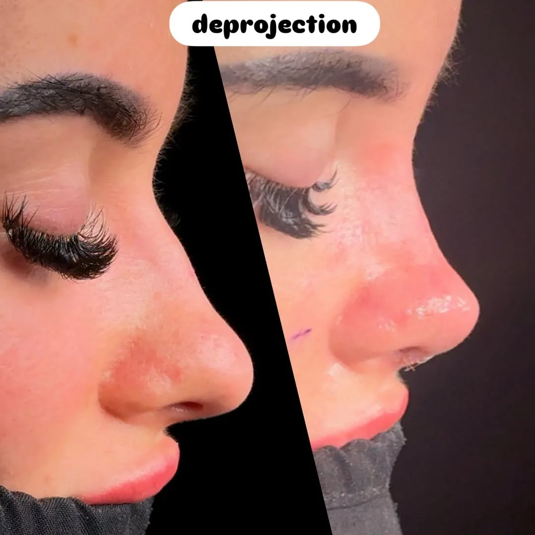 Deprojection nose surgery