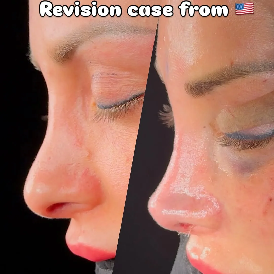 Revision rhinoplasty-1