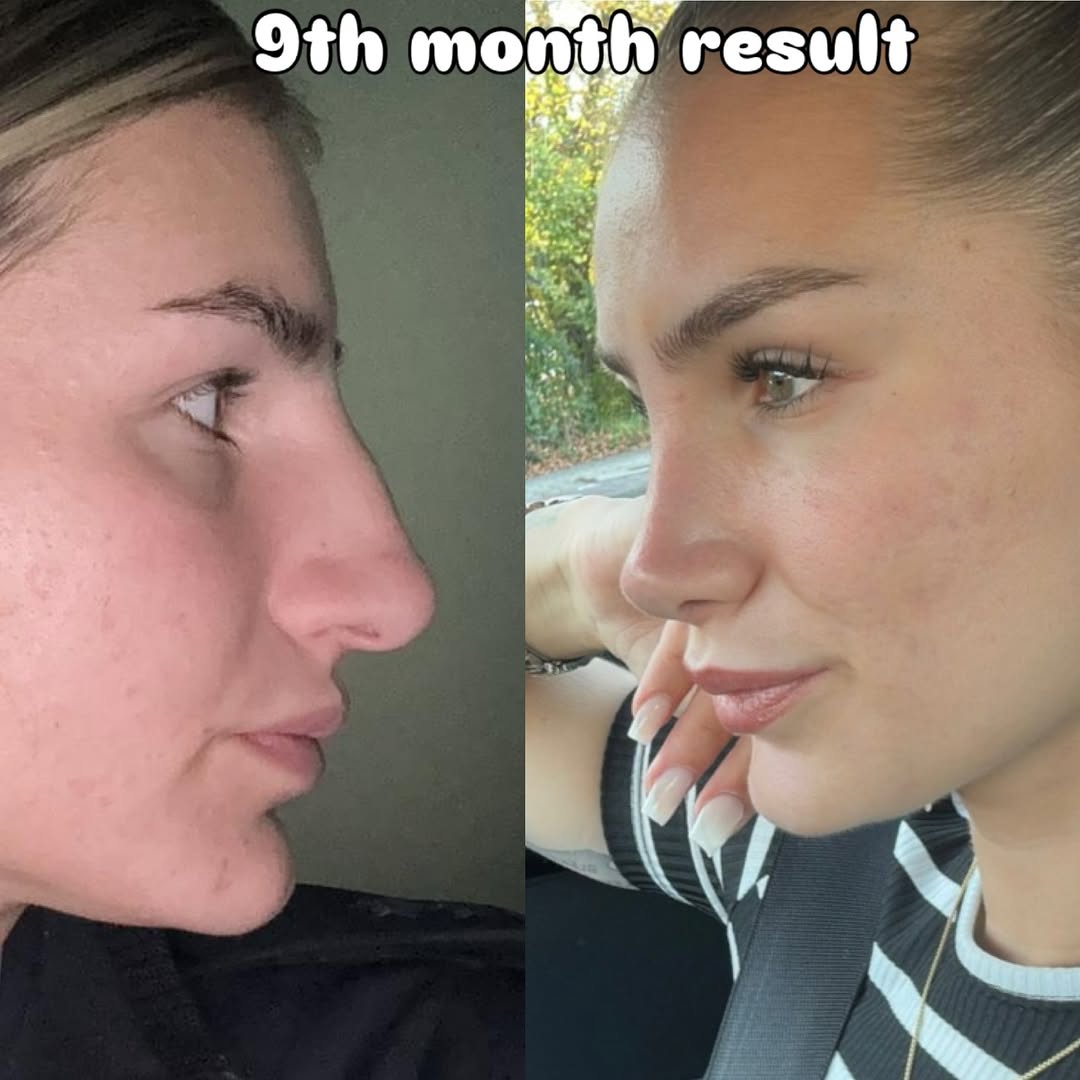 Piezo rhinoplasty-1 Piezo rhinoplasty-1