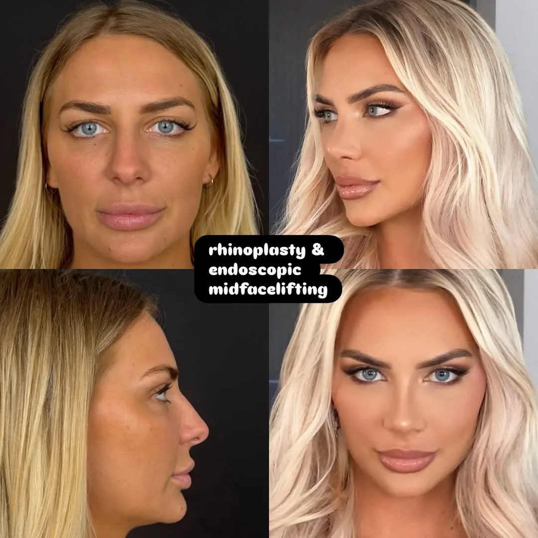 Revision rhinoplasty combined with an endoscopic midface lift-1