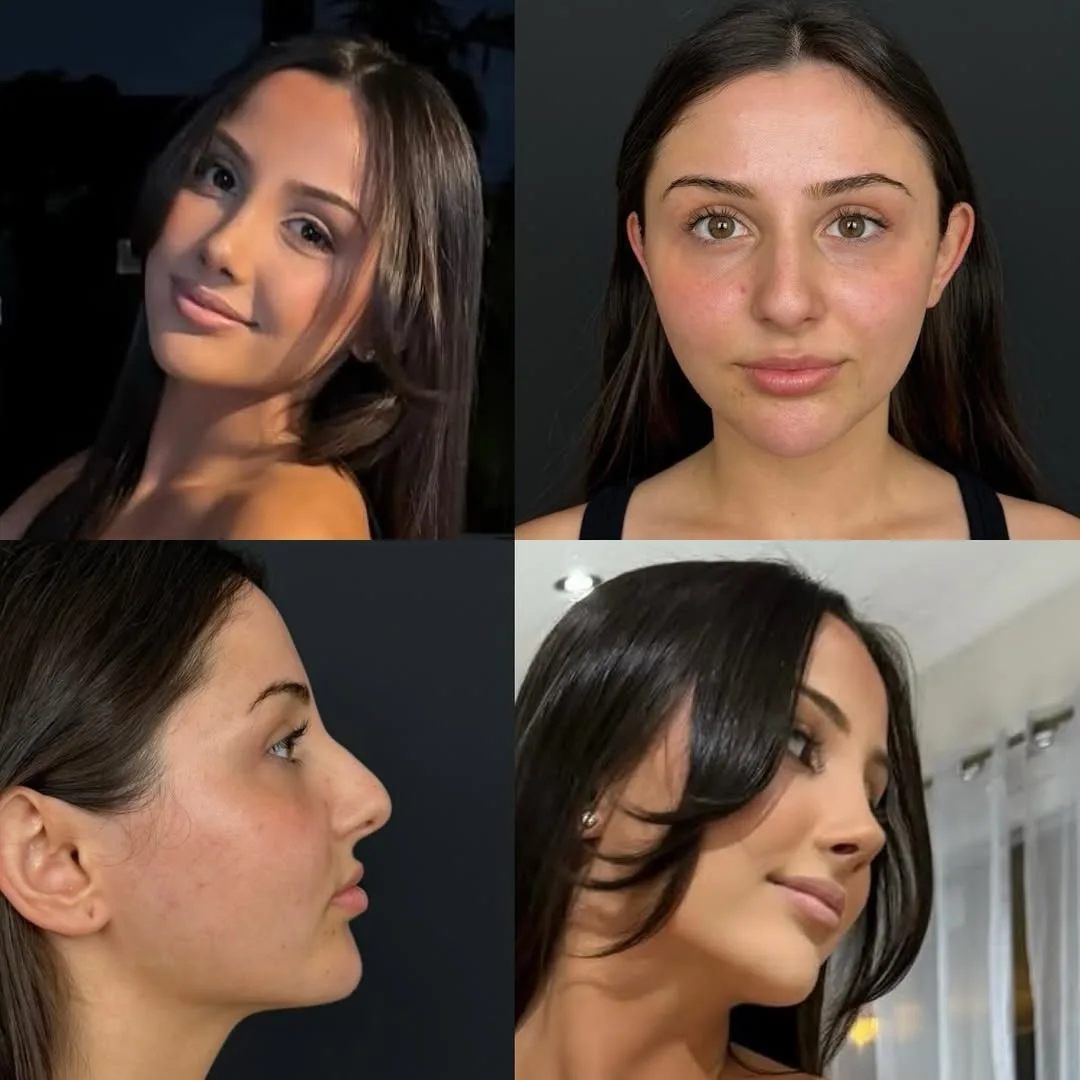 Half Babie half Natural nose