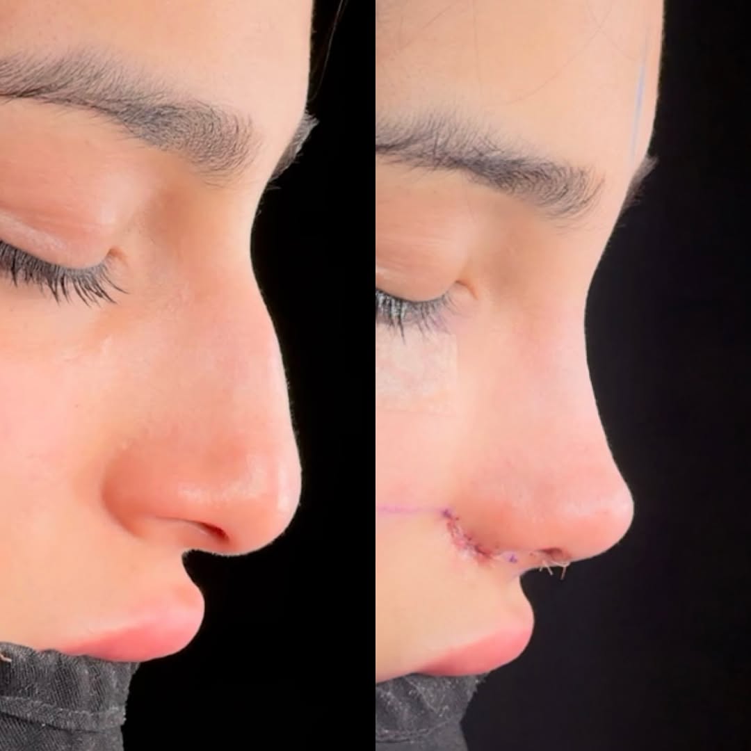 Natural nose Natural nose