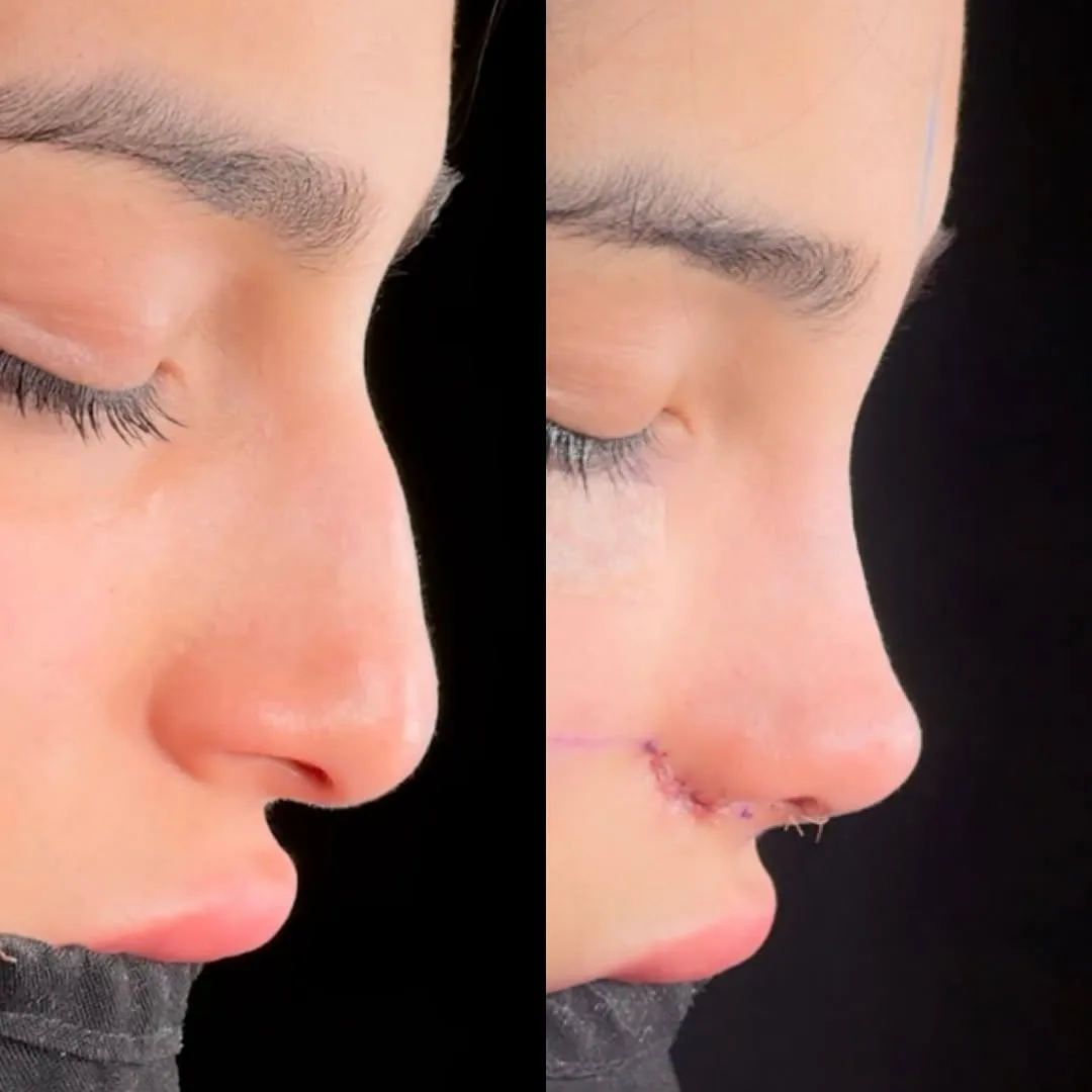 Natural nose