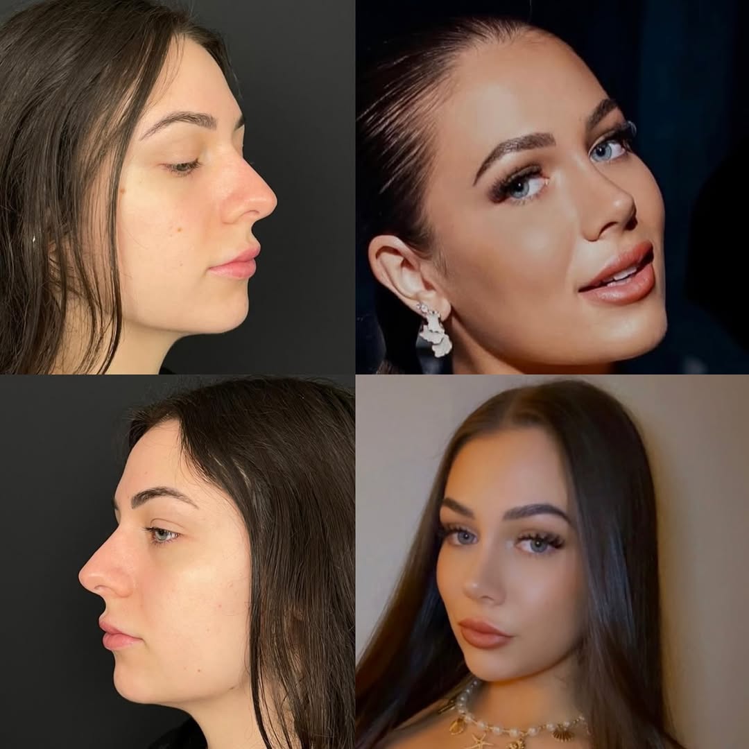 Rhinoplasty Long Term Results Rhinoplasty Long Term Results