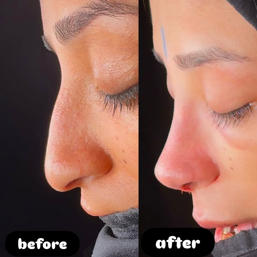 Primary Rhinoplasty-1 Primary Rhinoplasty-1