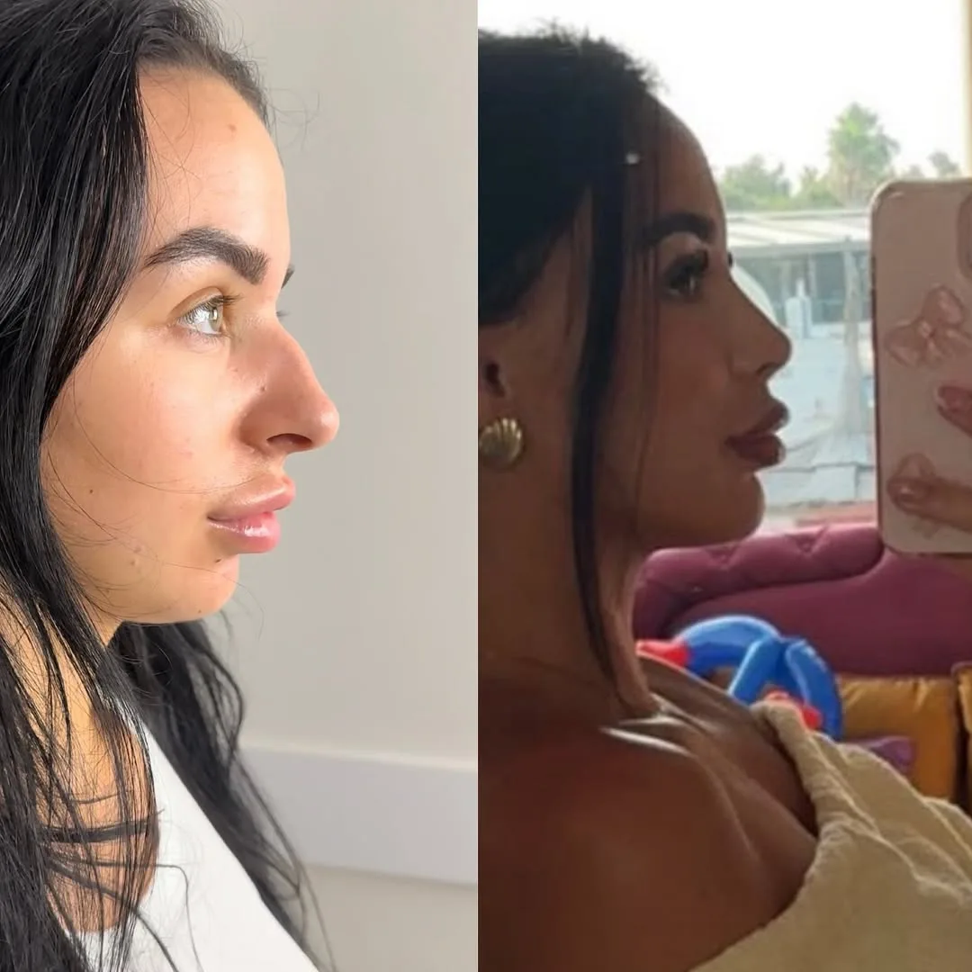 Rhinoplasty Long Term Results-1
