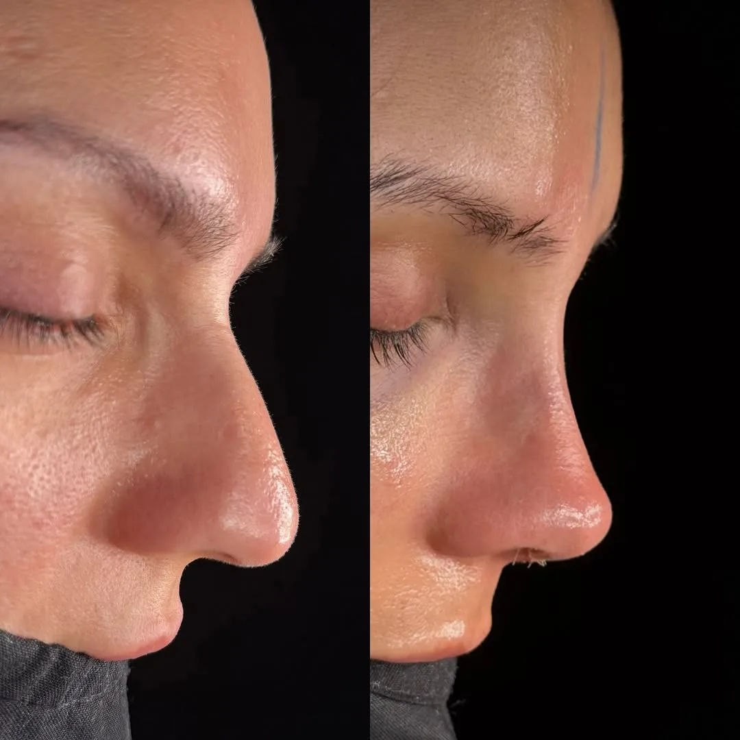 Deprojection nose surgery