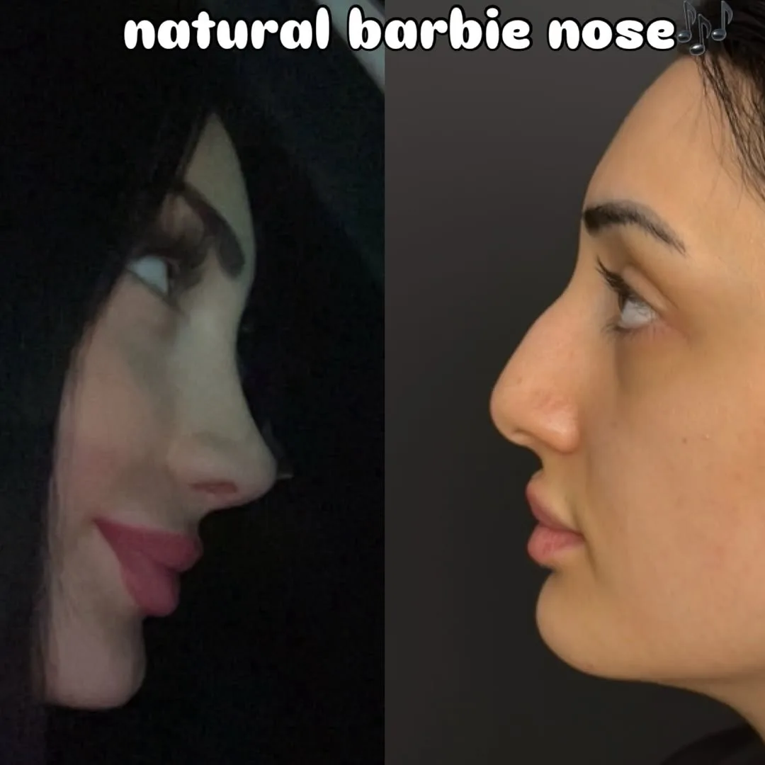 Natural Barbie nose style-3