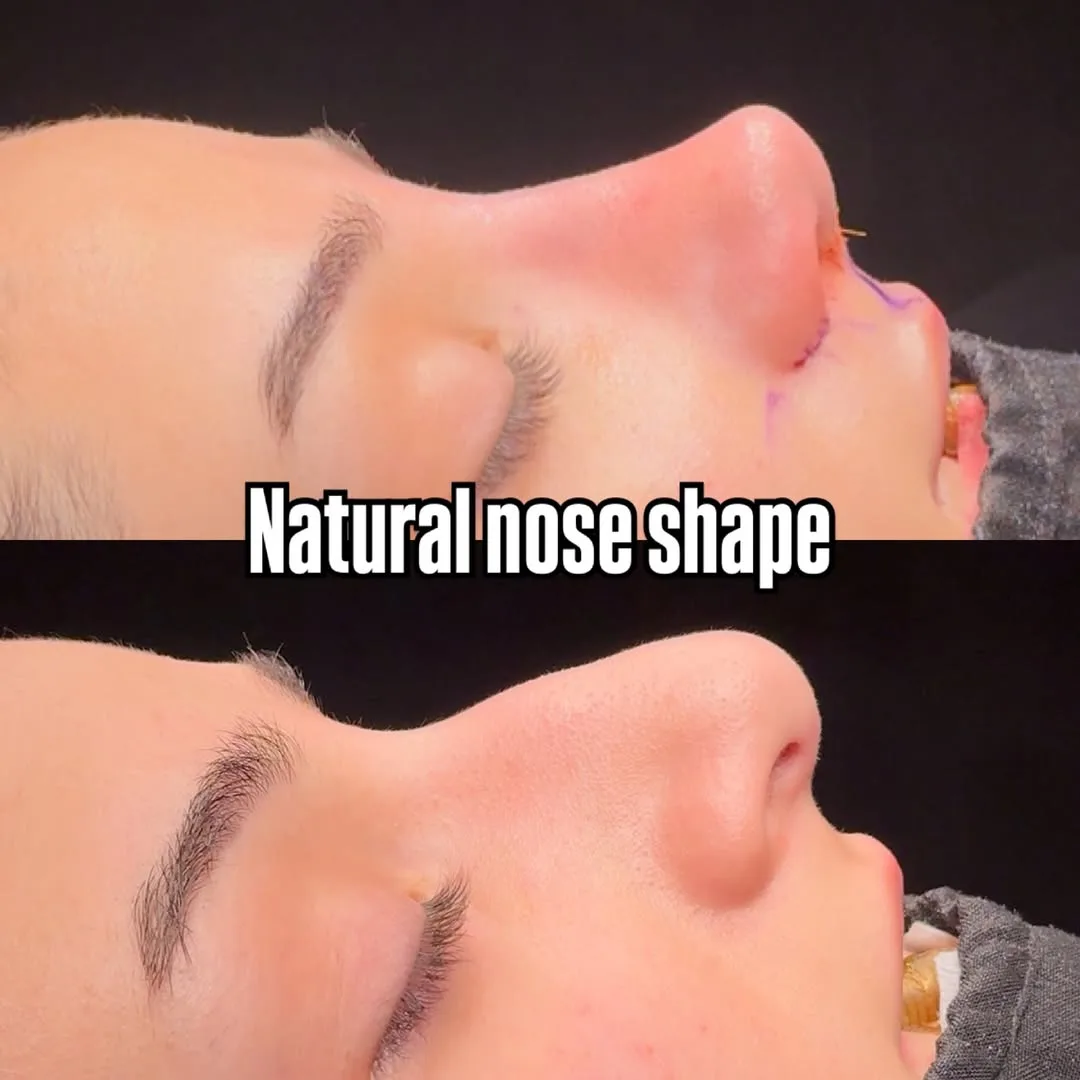 Piezo rhinoplasty