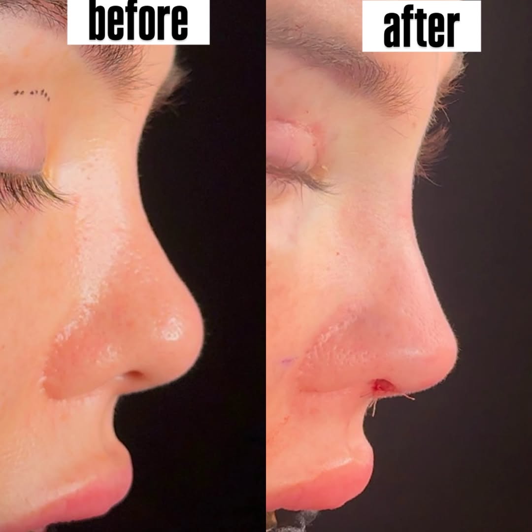 Revision Rhinoplasty Revision Rhinoplasty